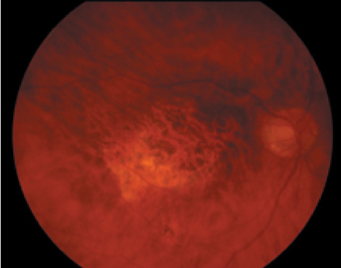 Age-Related Macular Degeneration Treatment Ohio