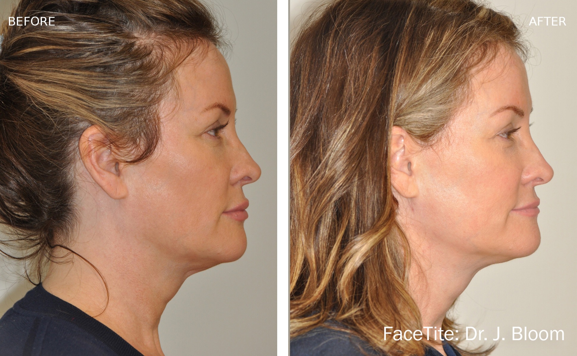 Face Tite pic5 - FaceTite Before after